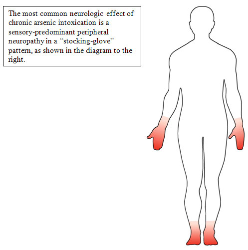 body showing where neuropathy happens