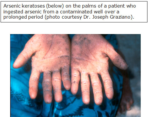 arsenic keratoses in the palms of a patient