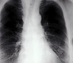 Chest radiograph of asbestosis in the lung