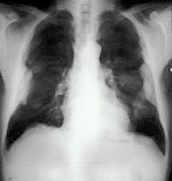 Chest radiograph showing bilateral pleural plaques