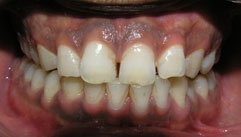 image of rotten gums