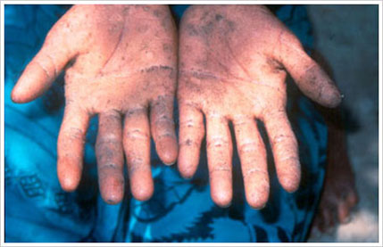 queratosis por arsénico en las palmas de las manos de un paciente