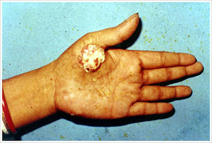 cáncer de piel en la palma de la mano